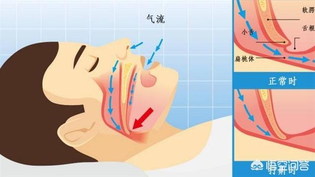 如何缓解打鼾？  打鼾 缓解 如何 第1张